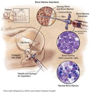 Read more about the article خزعة نقي العظم (Bone Marrow Biopsy)